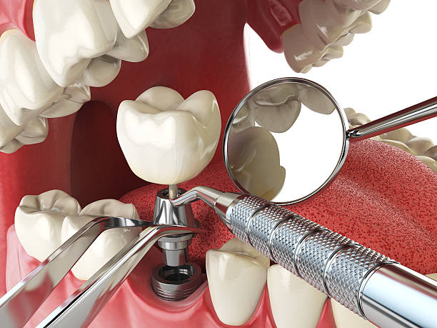 Best Emergency Wisdom Teeth Removal in Dovesville, SC
